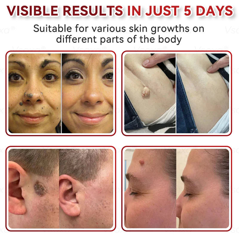 🔥 KUBOZN® Microneedle Skin Tag Removal Patches – Visible Results in 5 Days 🅱︎