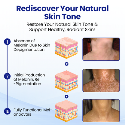 KUBOZN®Vitiligo Treatment Spray 🅱︎