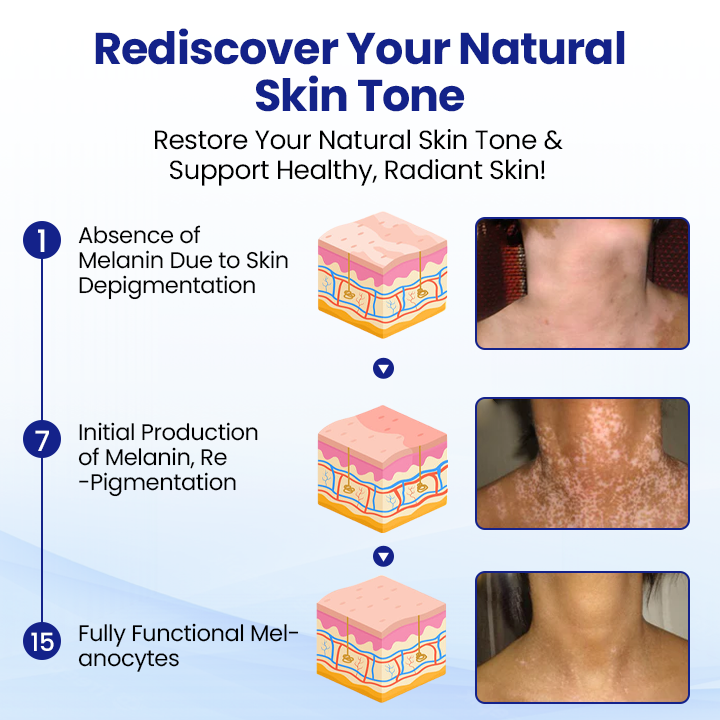 KUBOZN®Vitiligo Treatment Spray (offer)