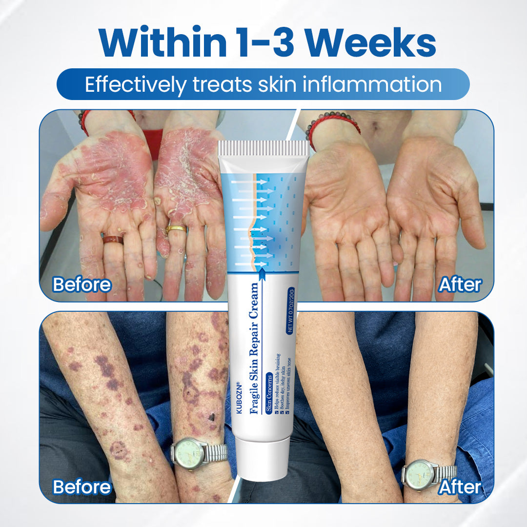 KUBOZN® Fragile Skin Repair Cream🛡️🌿 Multi-Repair for Bruises, Dryness & Spots