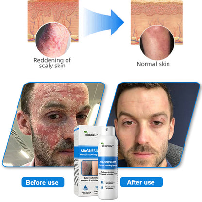 🔥KUBOZN® Magnesium Spray – Fast Relief for Itchy, Red & Sensitive Skin (Even Intimate Areas)