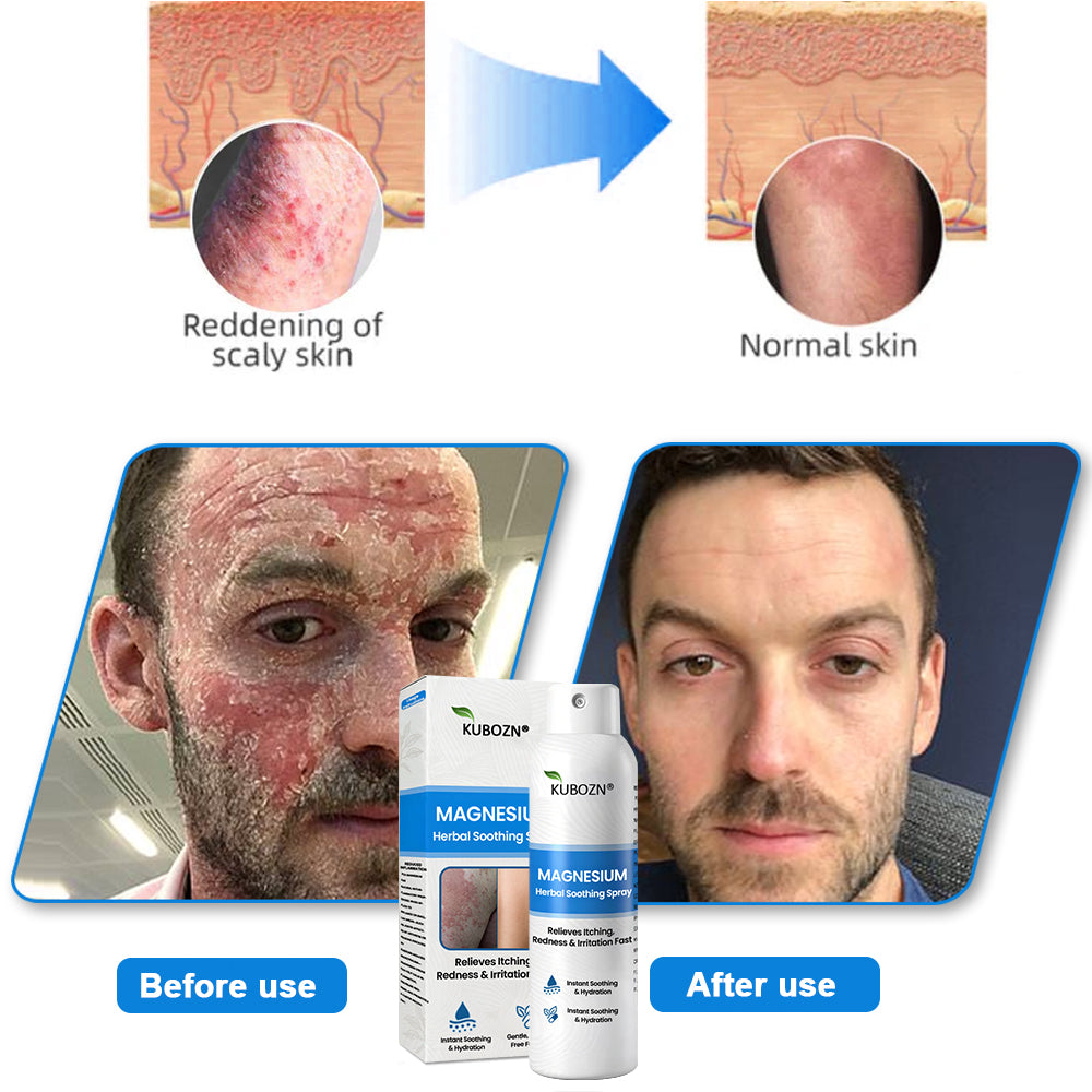 KUBOZN® Magnesium Herbal Spray – Fast Relief for Psoriasis & Eczema | No-Rub, Steroid-Free (offer）)