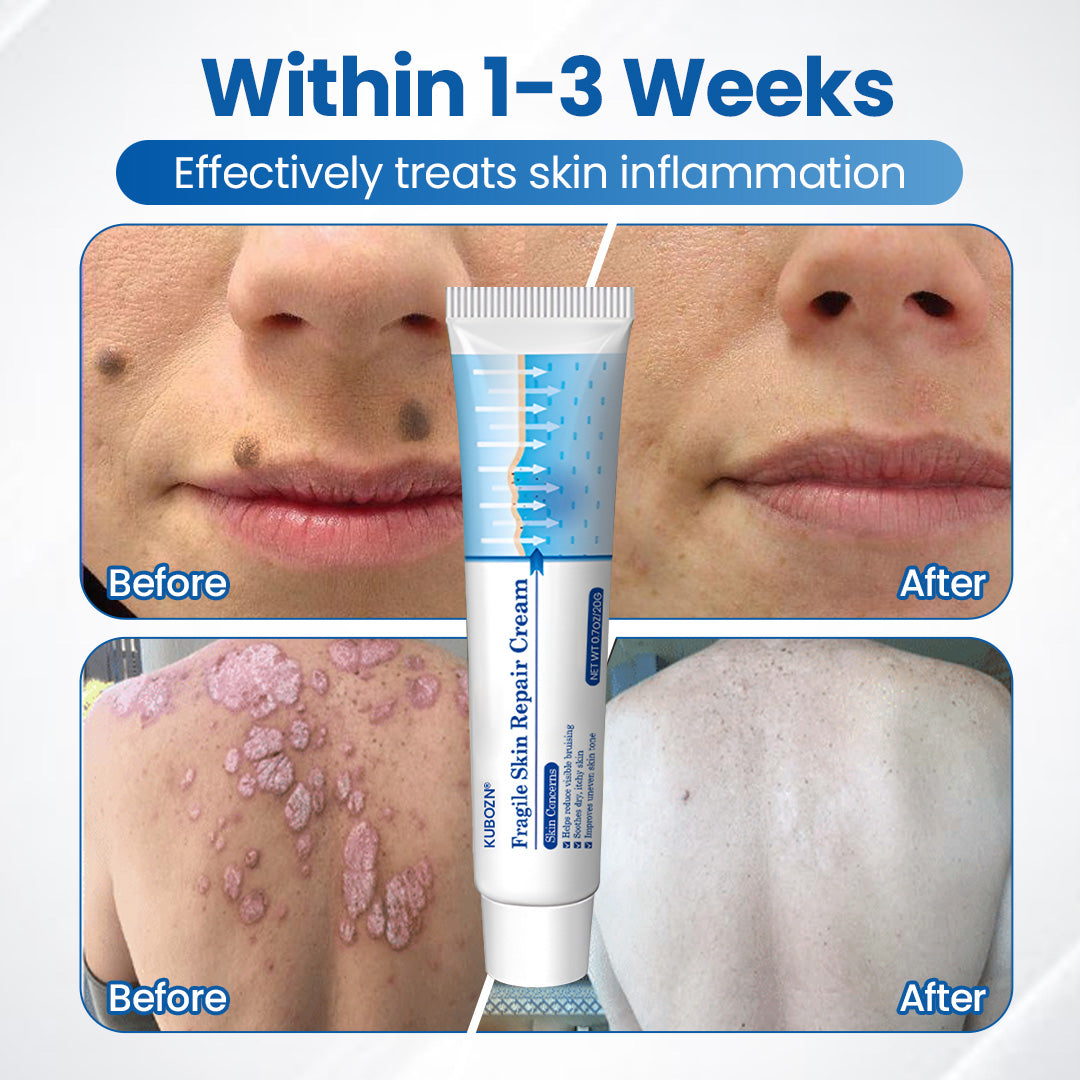 KUBOZN® Fragile Skin Repair Cream🛡️🌿 Multi-Repair for Bruises, Dryness & Spots