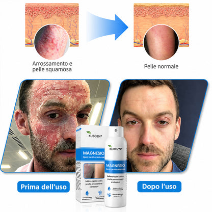 KUBOZN® Spray al Magnesio — Sollievo Rapido per Psoriasi ed Eczema