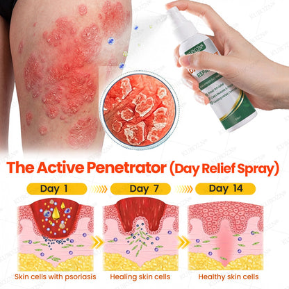 KUBOZN® 3-Min Itch Relief Psoriasis Cream – Steroid-Free Day & Night Treatment for Flaking, Scaling & Plaques