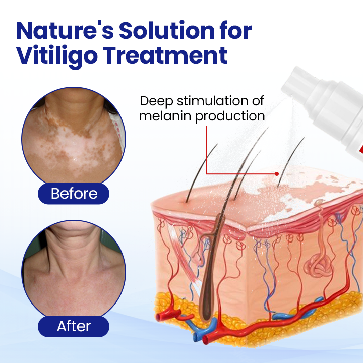 KUBOZN®Vitiligo Treatment Spray