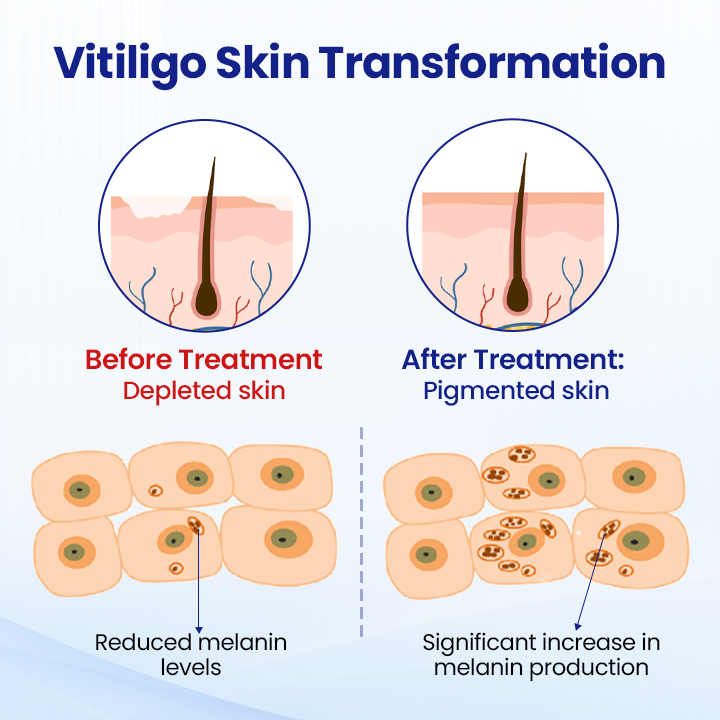 KUBOZN®Vitiligo Treatment Spray (offer)