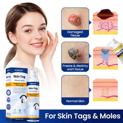 KUBOZN® CryoClear— Precision Cryo Spray for Skin Tag Removal