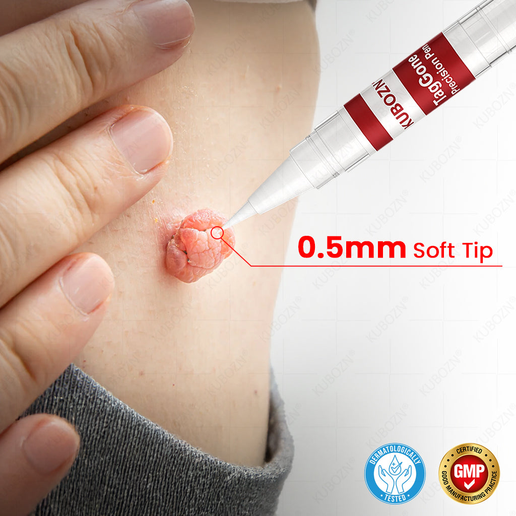 ✨KUBOZN® TagGone Precision Pen (2025 Upgrade) | Skin Tag, Mole & Wart Remover – Fast, Gentle & Scar-Free in 5 Days 🅱︎