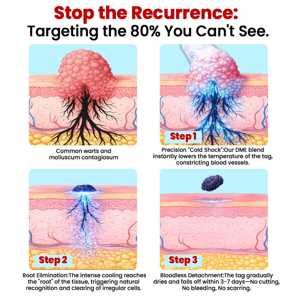KUBOZN® CryoClear— Precision Cryo Spray for Skin Tag Removal