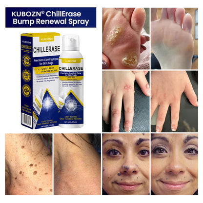 KUBOZN® ChillErase Cooling Spray for Skin Tags 🅱︎